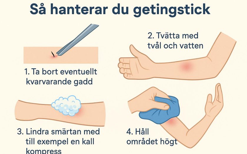 Vad är det bästa sättet att hantera getingstick?